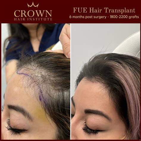 Female Hair Restoration in Beverly Hills, CA | Female Hair Restoration