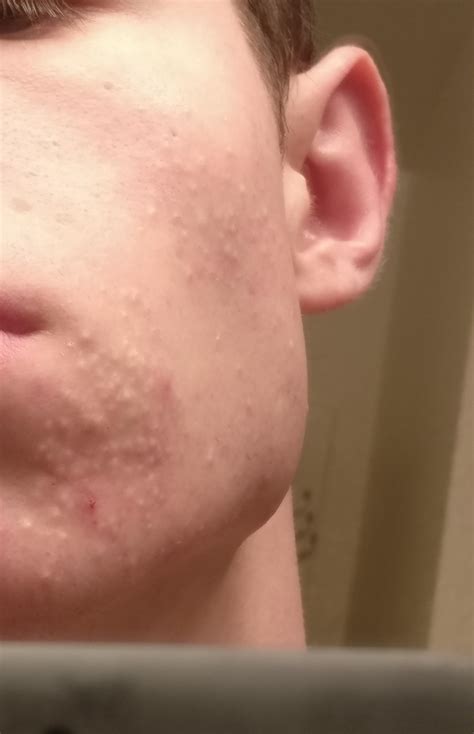 [acne] Help with skin colored bumps! : r/SkincareAddiction