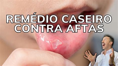 O Que É Bom Para Afta Caseiro - Remédio Caseiro para Aftas | RECEITA NA LEGENDA - YouTube