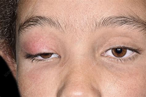 periorbital cellulitis stock image  science photo library