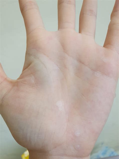 Tiny warts all over my hands : r/Warts