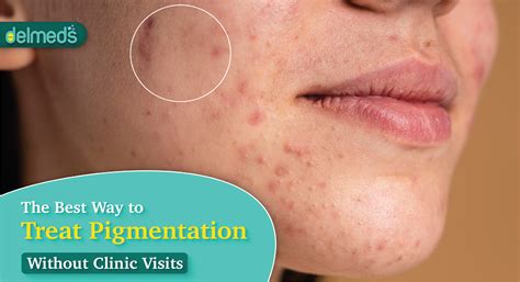 how to treat pigmentation 8