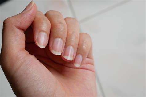 Iron Deficiency Anemia Nails