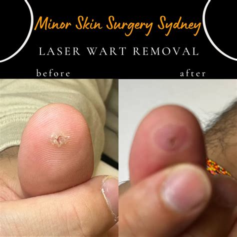 warts  fingers removal wart removal techniques  prevention