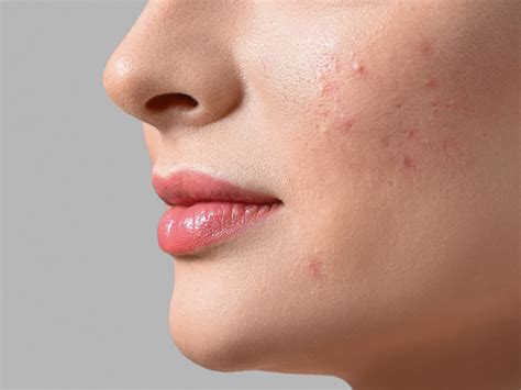 blemishes explained le petit blog