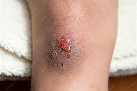 premium photo fresh skin wound   scraped knee   child
