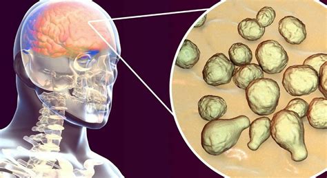 understanding  severity  transmission  bacterial meningitis