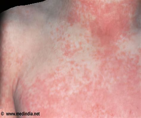 facts  rheumatic fever  facts  rheumatic  vrogueco