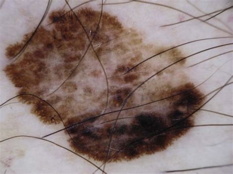 malignant melanoma clinical gate