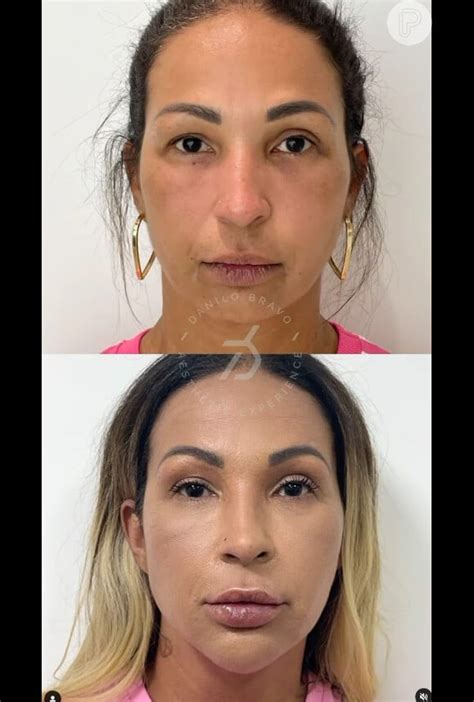 Valesca Antes E Depois - Valesca Popozuda antes e depois! Funkeira mostra novo rosto após três ...