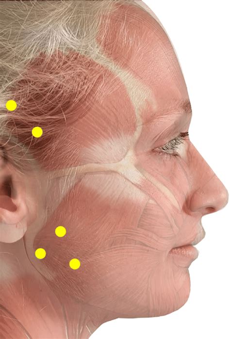 Masseter Botox Injection Technique