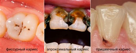Кариес зубов — Виды и симптомы. Лечение | Стоматология ЭлитДентал М.