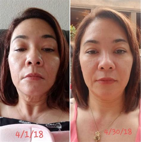 UltraSlim® Before and After Photos | Verona Spine & Wellness