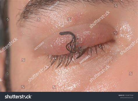 Symblepharon Images, Stock Photos & Vectors | Shutterstock