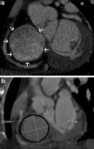 tricuspid stenosis ct scan wikidoc