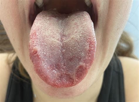 is this geographic tongue AND oral thrush? My tongue usually gets