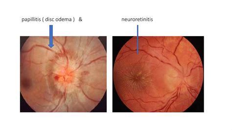 pediatric uveitis  optic disc edema bmaigh