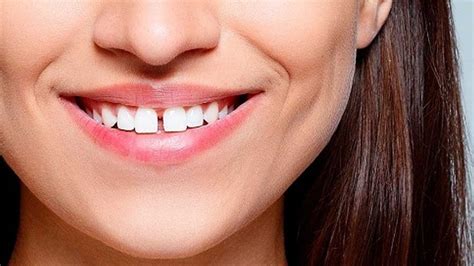 rang cua la rang nao cach khac phuc rang cua thua