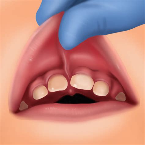 Laser Tongue and Lip Tie Treatment Newcastle - Cardiff - Singleton - Fletcher