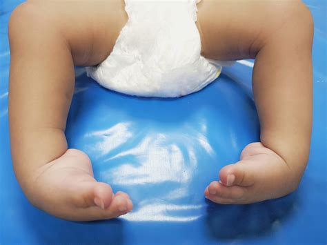 Signs Of Clubfoot at Ava Lazarev blog
