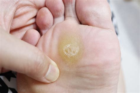 whats  difference  foot corns  foot calluses foot