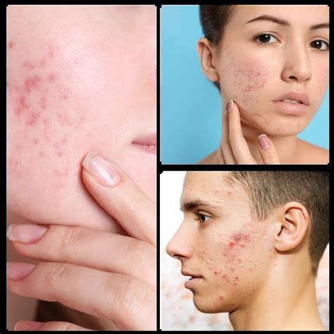 how to get rid of melasma 1