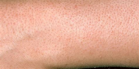 Does diet affect keratosis pilaris?