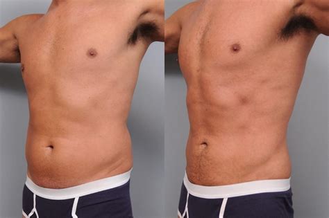 liposuction    men