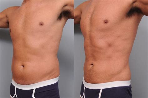 Liposuction Before And After Men