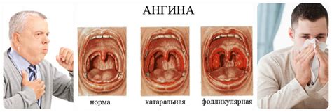 Как выглядит рак легких на флюорографии фото