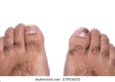 124 Blood Under Toenail Images, Stock Photos & Vectors | Shutterstock