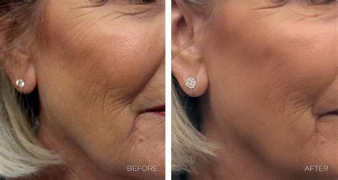Neck Lift Alternatives: Surgical & Non-surgical Options | Omaha ...