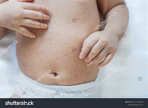 Baby Toddler Scratching Chickenpox Rash On Stock Photo 2111314748 | Shutterstock