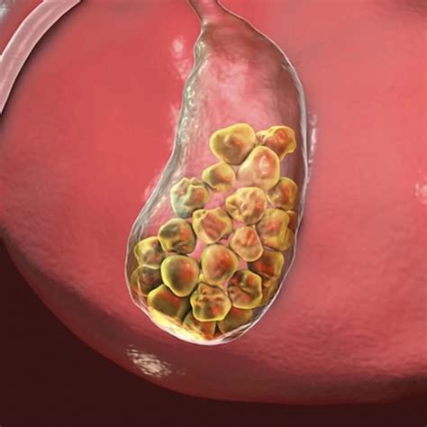 Qual O Tamanho Da Pedra Na Vesícula Para Cirurgia