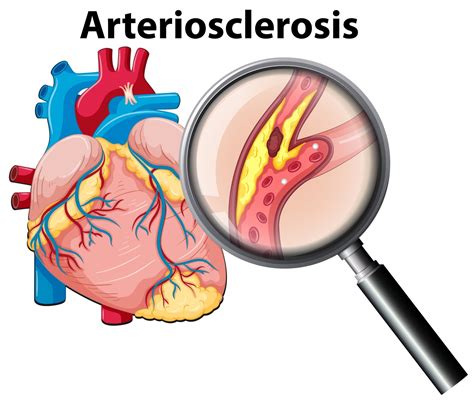 Arteriosclerosis - CMC - Centro Médico Cardiovascular