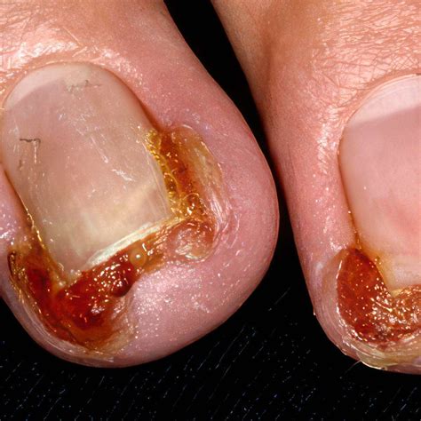 how to fix an infected hangnail
