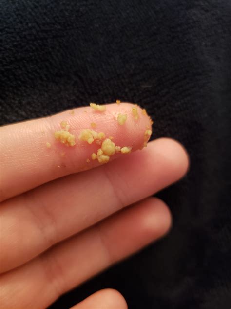 731 best Tonsil Stones images on Pholder | Tonsilstones