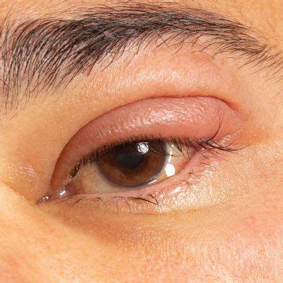 ¿Por qué salen los orzuelos en los ojos y cómo se curan? - Gastropatios
