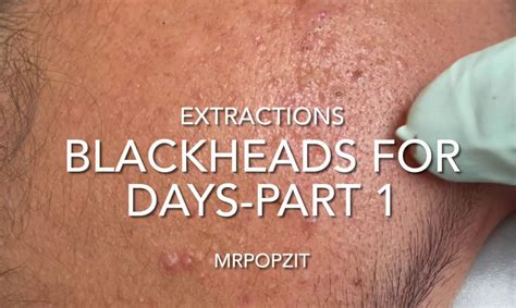 juicy blackhead pops 9