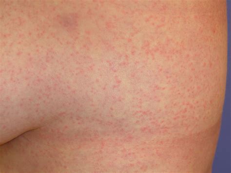 viral rash  toddlers