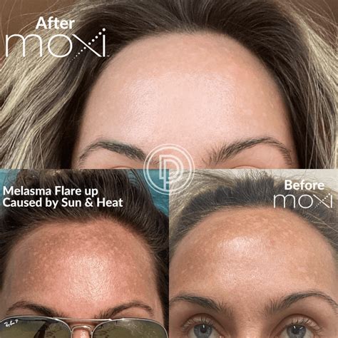 levisa lazer: Before & After Photos That Will Amaze You - 0pk55zc