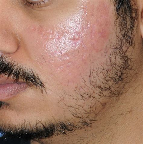 Acne Scar Treatment Before After Photos Seattle Bellevue