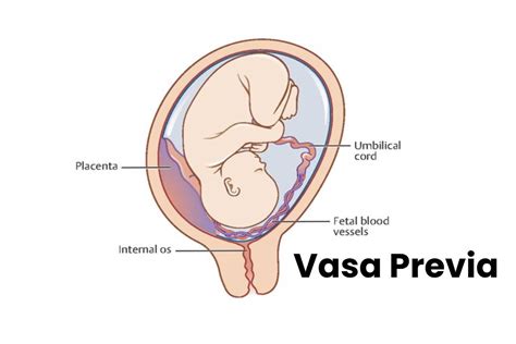 What is Vasa Previa? – Symptoms, Causes, Diagnosis, and More