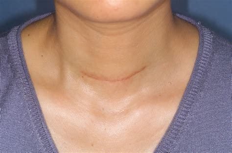 Armour Thyroid Before And After