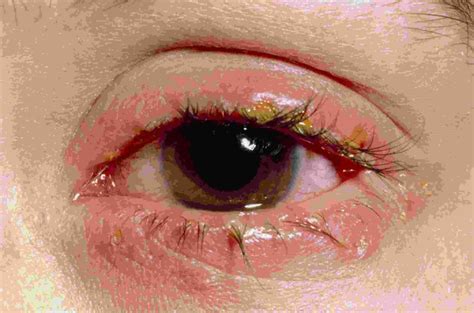 Eye Discharge and Associated Eye Problem | Eyemantra