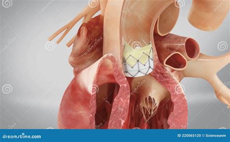 Aortic Prosthesis Surgery Attachment of Artificial Prosthetic Aortic ...