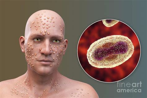 smallpox virus infection  photograph  kateryna konscience photo