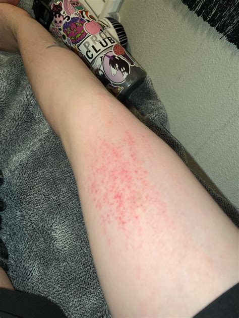 itchy spots  skin rdiagnoseme