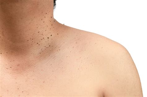 What are Skin Tags? - Mole Removal Orange County
