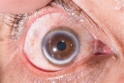 arcus senilis store medisinske leksikon